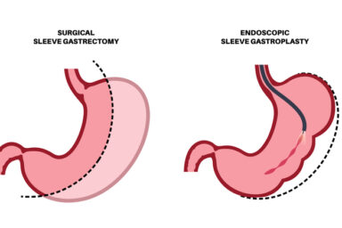 Gastrectomy and gastroplasty